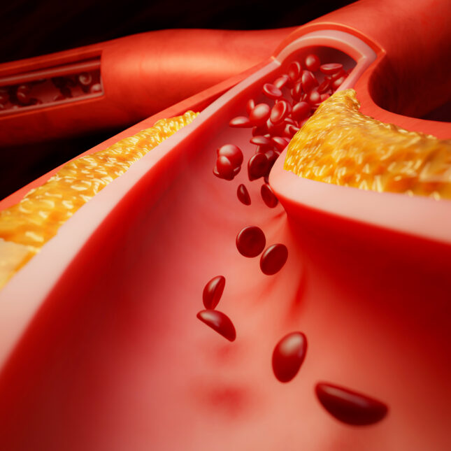 Bristol Myers, J&J’s Next-Gen Blood Thinner Fails Key Trial in Another Setback for Factor XI